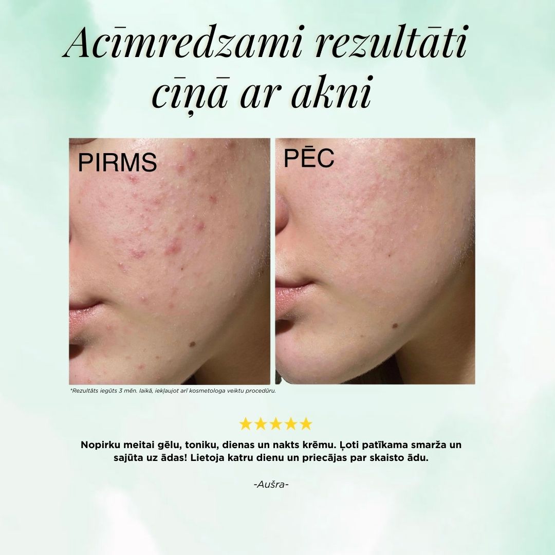 ANTI-ACNE TONIKS, 2. Solis, 200ml
